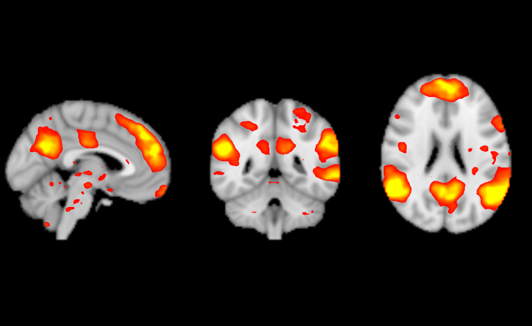MRI, displaying how blood oxygen levels change in the brain - brain scan alt