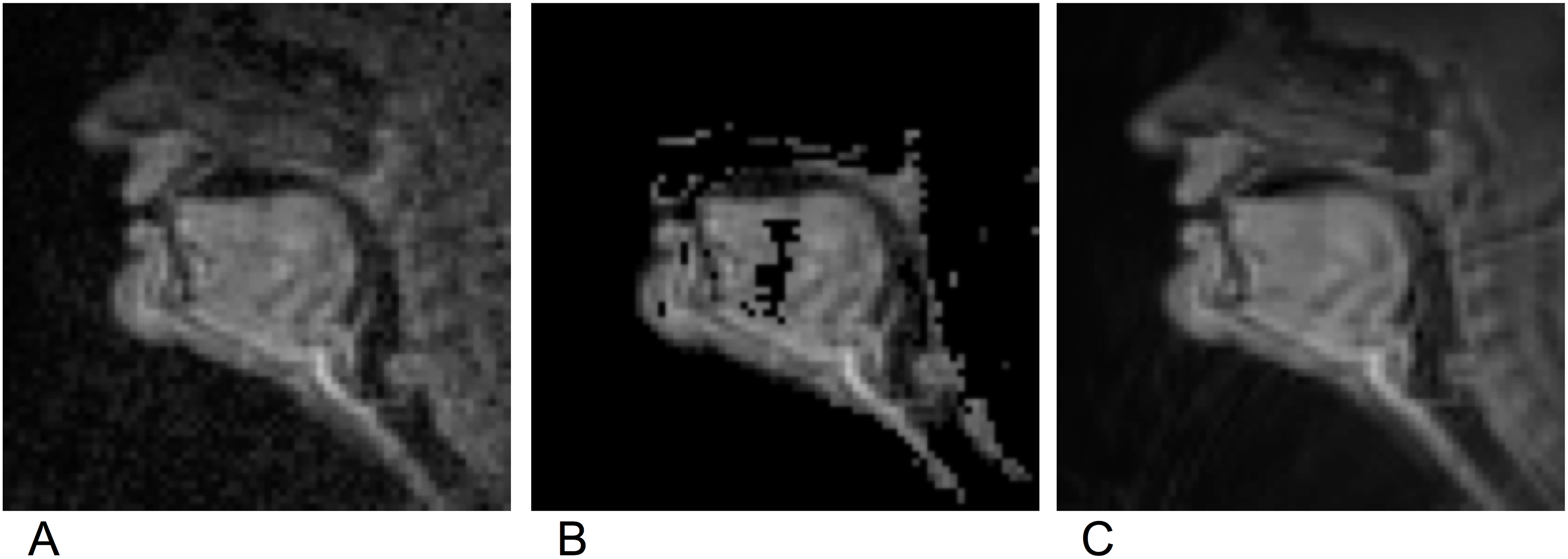 MRI Scan - Side Profile of face