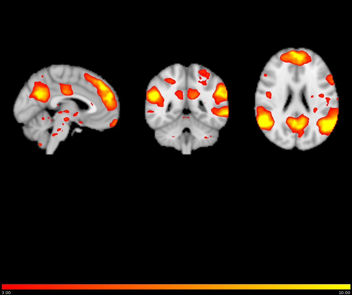 MRI Scan of 3 views of the brain